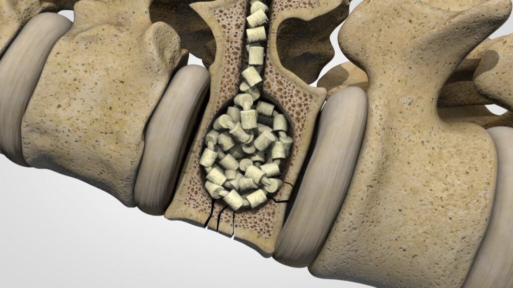 Close-up of a bone cross-section showing spinal vertebrae and intervertebral discs.