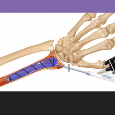 An image of an illuminoss skeleton with a surgical tool attached to it.
